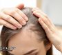 What Is the Best Treatment for Hair Fall and Thinning Hair in Toronto 90x80